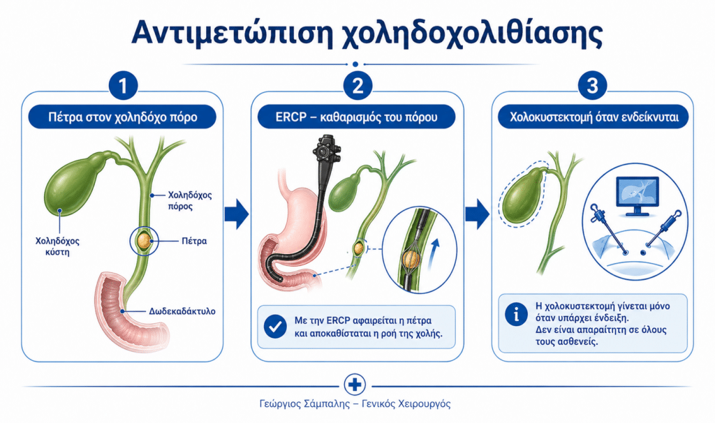 Αντιμετώπιση χοληδοχολιθίασης με ERCP και χολοκυστεκτομή όταν ενδείκνυται