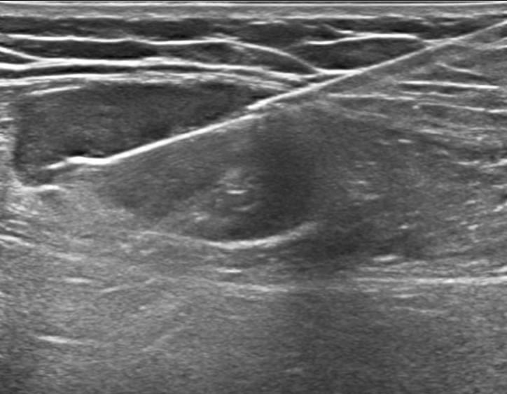 Core Biopsy