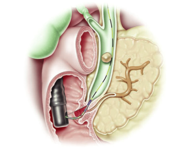 ERCP πριν από τη χολοκυστεκτομή