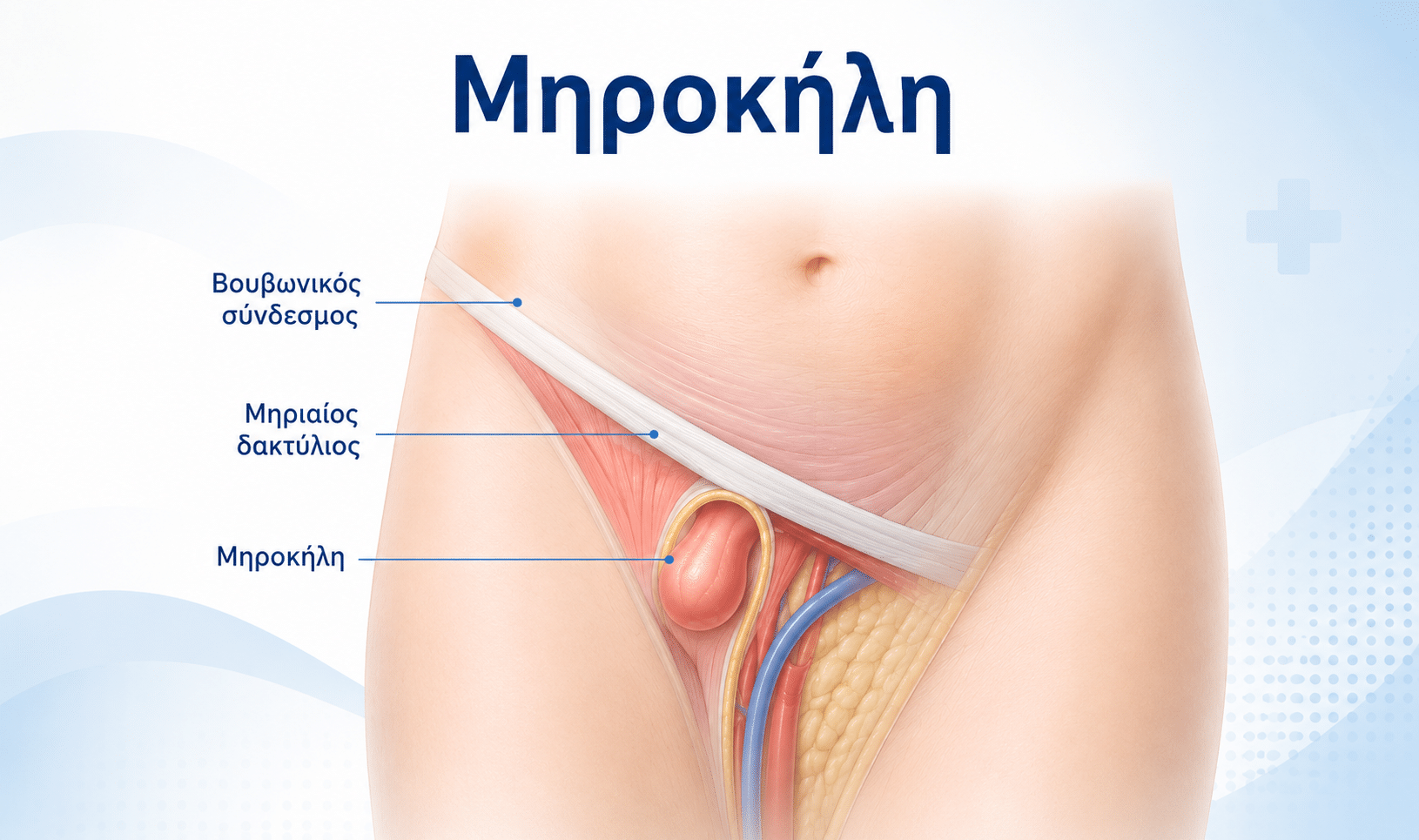 Η μηροκήλη εμφανίζεται χαμηλότερα από τη βουβωνοκήλη, στην περιοχή του μηριαίου δακτυλίου.