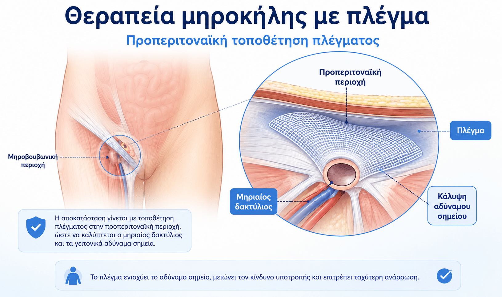Χειρουργική θεραπεία μηροκήλης με προπεριτοναϊκή τοποθέτηση πλέγματος