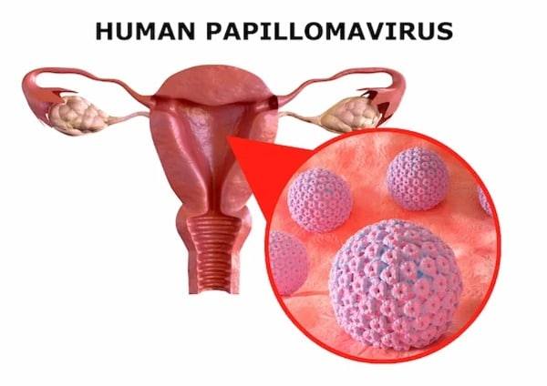 HPV στις γυναίκες