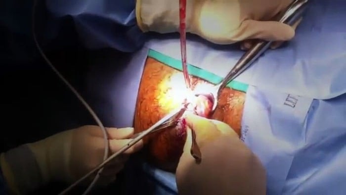 Αιμορροΐδες με Laser