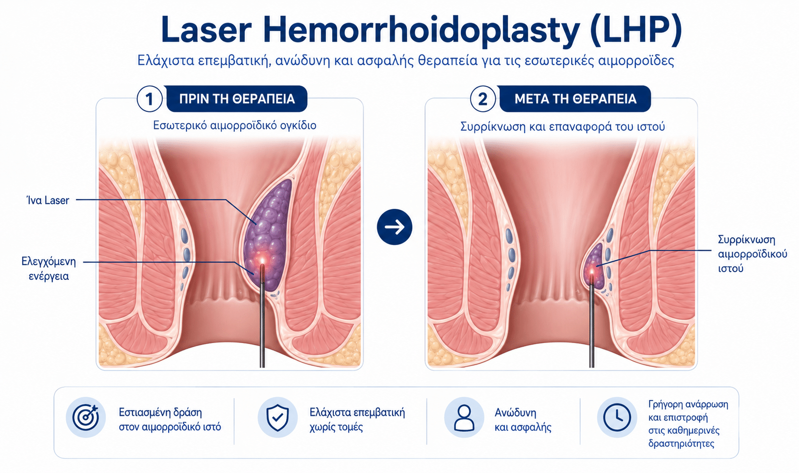 Laser Hemorrhoidoplasty LHP για συρρίκνωση εσωτερικών αιμορροΐδων
