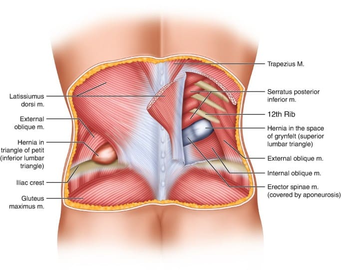 Οσφυϊκή κήλη (Lumbar hernia: Grynfeltt–Lesshaft / Petit) 