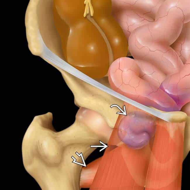 Θυροειδής κήλη (Obturator hernia) 