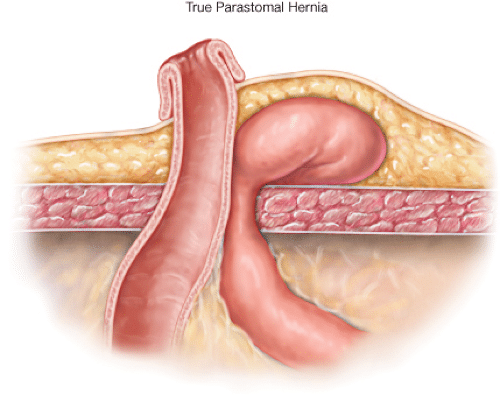 Παραστομιακή Κήλη (Parastomal Hernia)