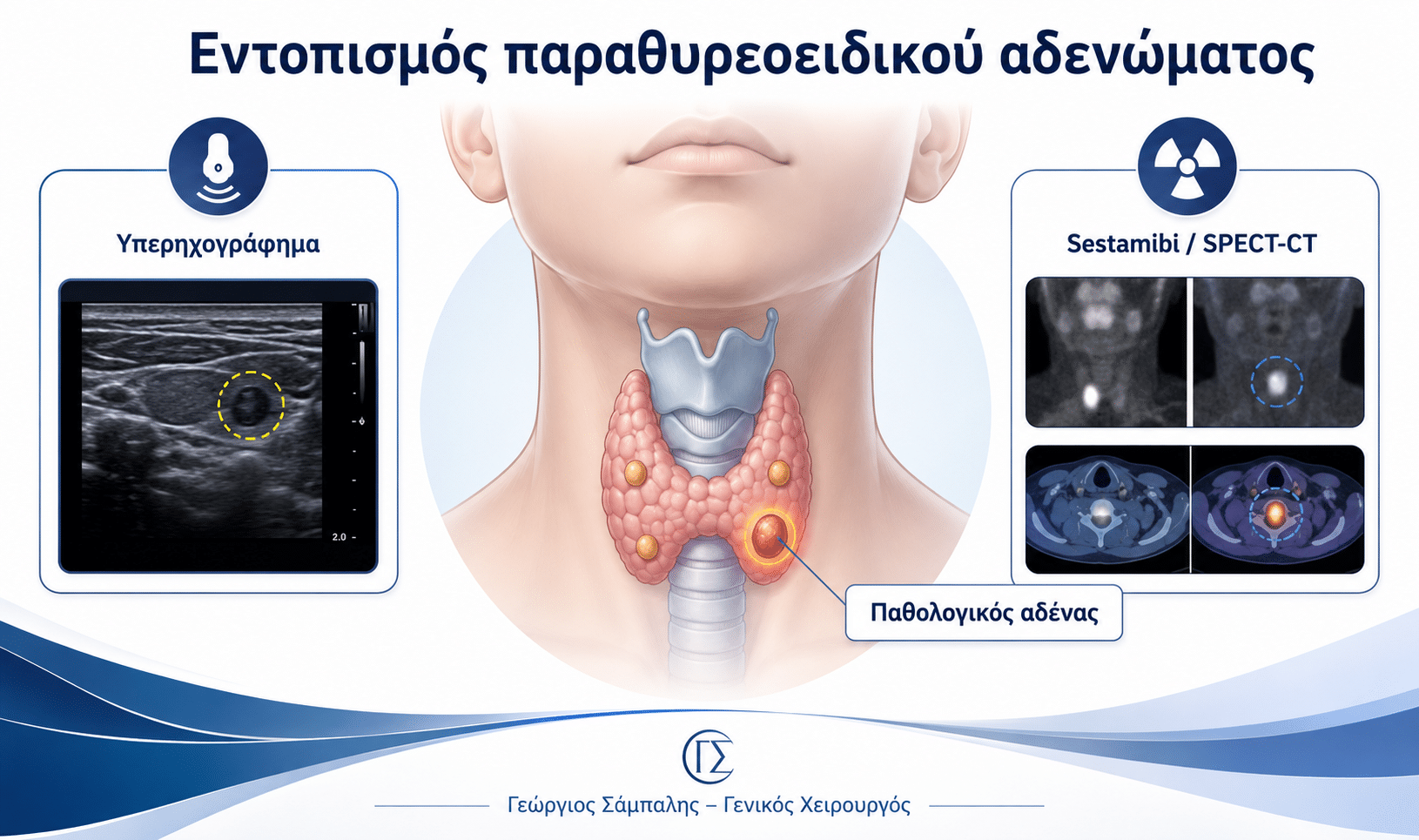 Εντοπισμός αδενώματος παραθυρεοειδούς με υπερηχογράφημα και sestamibi
