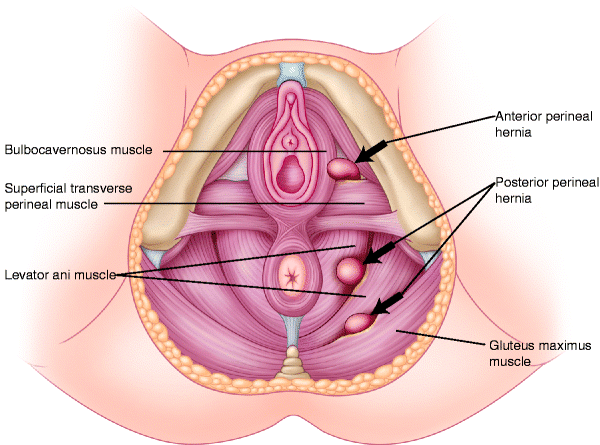 Περινεϊκή κήλη (Perineal hernia)