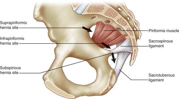 Ισχιακή κήλη (Sciatic hernia)