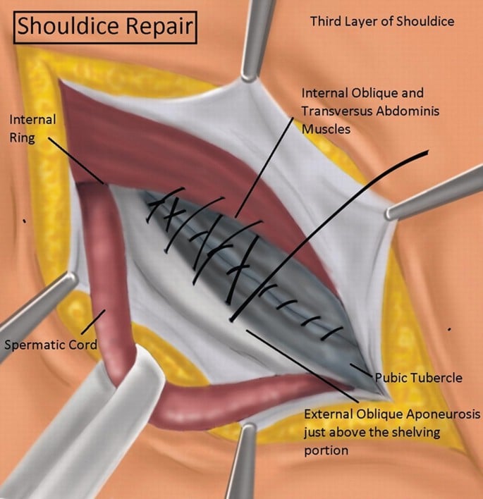 Shouldice (χωρίς πλέγμα – “tissue repair” πολλαπλών στρωμάτων)