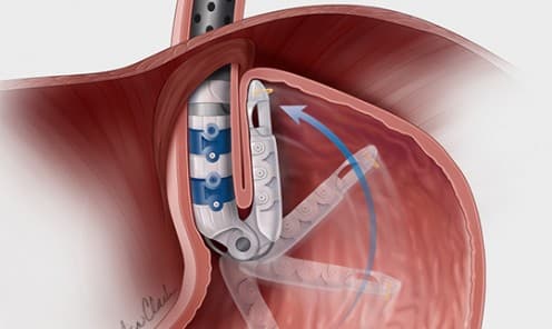 Transoral Incisionless Fundoplication