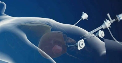 Η Λαπαροσκόπηση πλεονεκτεί στις επεμβάσεις του Εντέρου