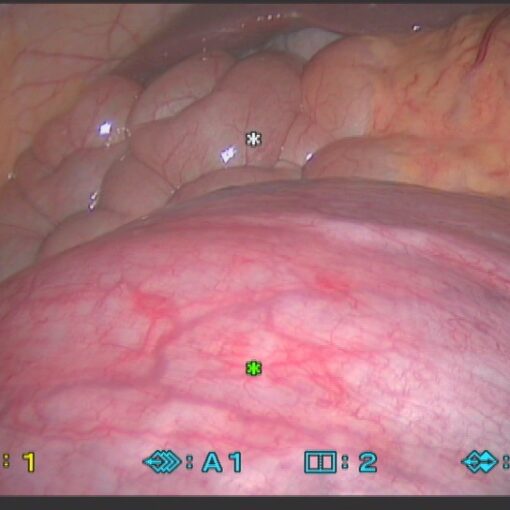 Επείγουσα χολοκυστεκτομή σε έγγυο