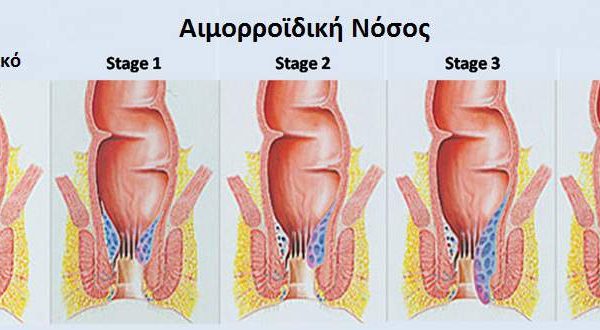 Στάδια αιμορροϊδικής νόσου - Αιμορροϊδεκτομή