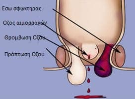 Αιμοροϊδες - Ανατομία- Αιμορροϊδεκτομή