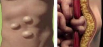 Αποτελέσματα Μεθόδου TEP για Βουβωνοκήλη