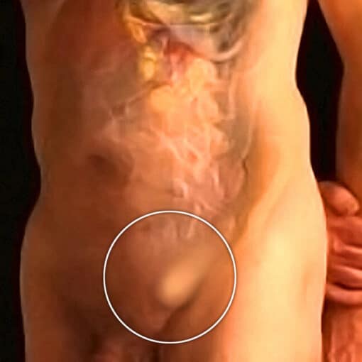 Χειρουργική Βουβωνοκήλης