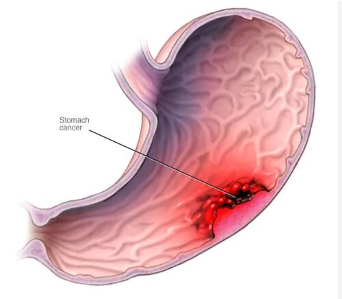 Gastric_cancer - Γεώργιος Σάμπαλης Καρκίνος Στομάχου