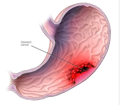 Καρκίνος Στομάχου