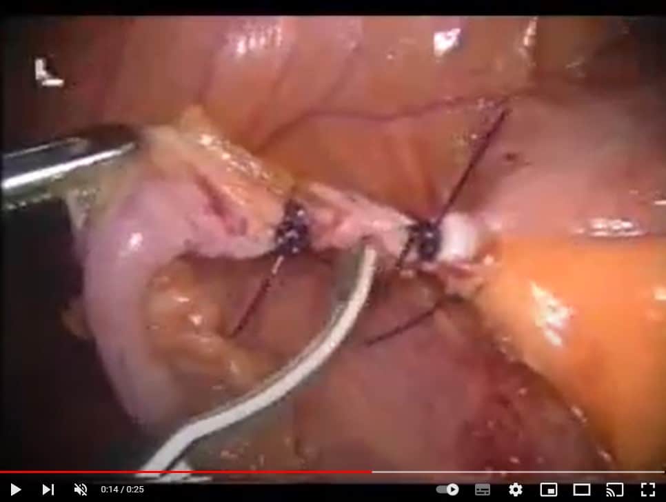 Video_lap_appendix - Γεώργιος Σάμπαλης Λαπαροσκοπική Σκωληκοειδεκτομή