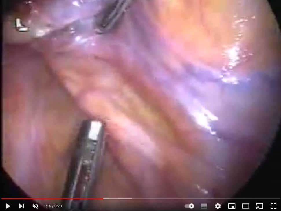 Video_left_colectomy - Γεώργιος Σάμπαλης Λαπαροσκοπική Αριστερή Κολεκτομή