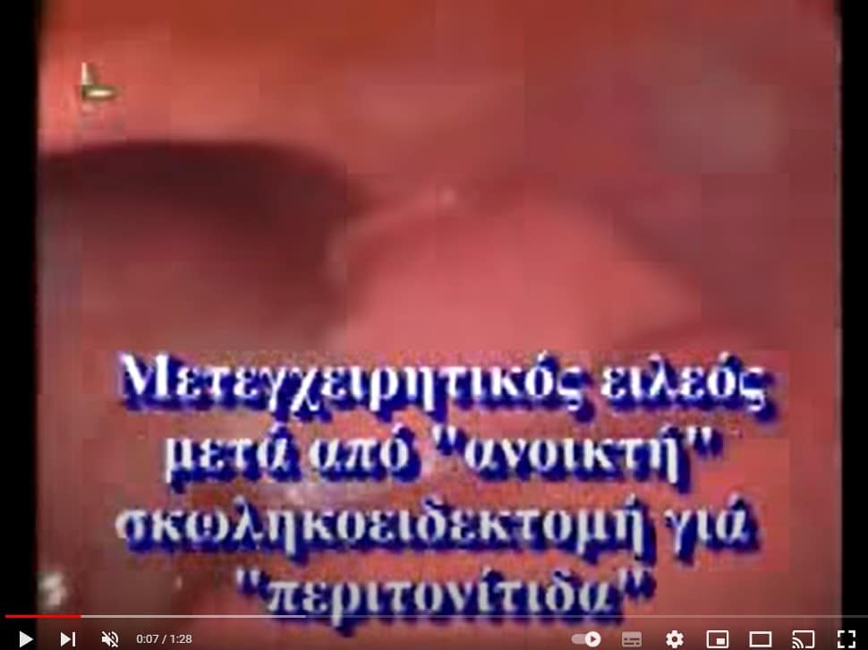 Video_potop_ileus - Γεώργιος Σάμπαλης Λαπαροσκοπική αποκατάσταση Ειλεού Λεπτού Εντέρου