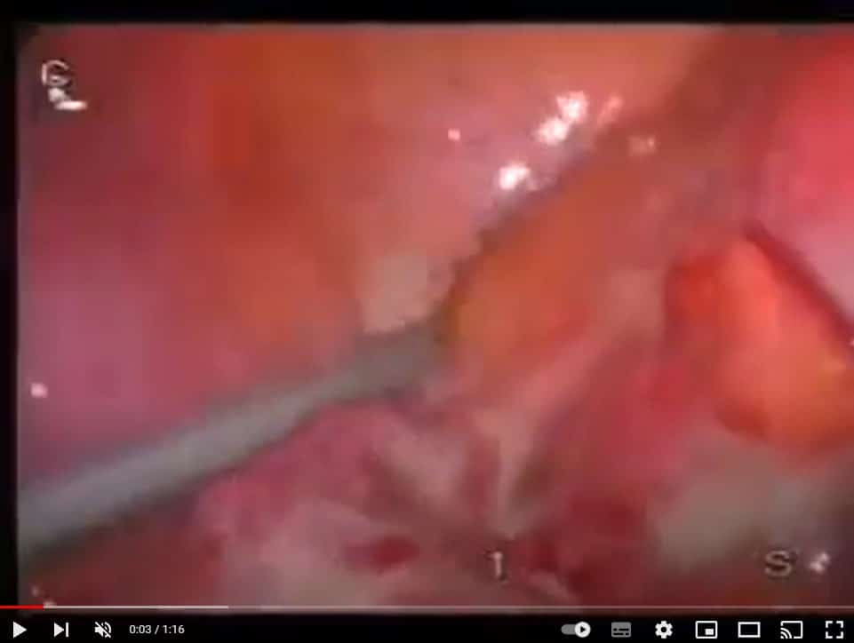 Video_ruptured_appendix - Γεώργιος Σάμπαλης Λαπαροσκοπικη παροχετευση οπισθοτυφλικού αποστήματος