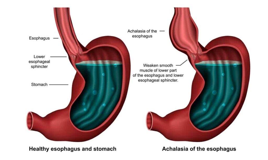 achalasia - Γεώργιος Σάμπαλης Αχαλασία οισοφάγου
