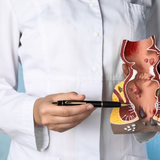 Αιμορροϊδεκτομή