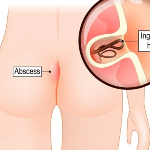 Κύστη Κόκκυγος