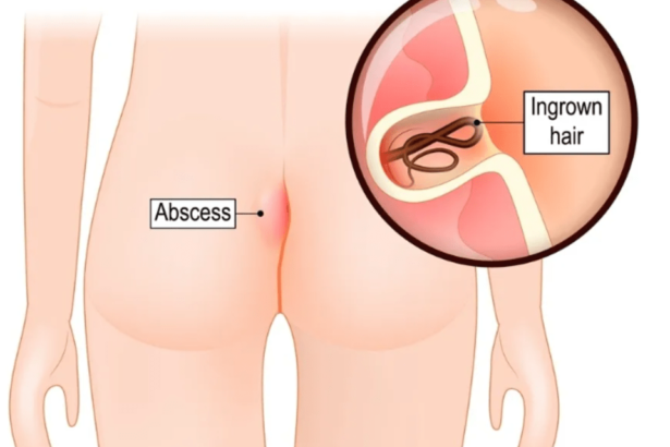 Κύστη Κόκκυγος