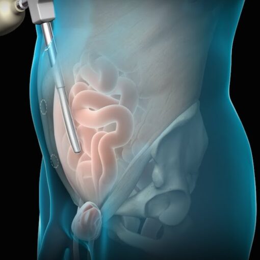 Λαπαροσκοπική επέμβαση TEP για κήλη