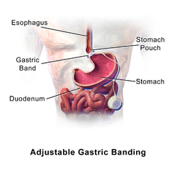 Blausen_0601_LaparoscopicGastricBanding - Γεώργιος Σάμπαλης Ερωτήσεις μετά την επέμβαση δακτυλίου