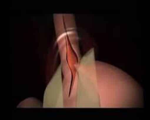 Ρομποτική Χειρουργική Αχαλασίας Οισοφάγου