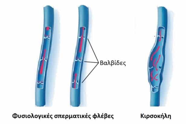 Κιρσοκήλη