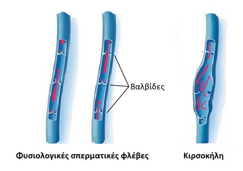 Κιρσοκήλη