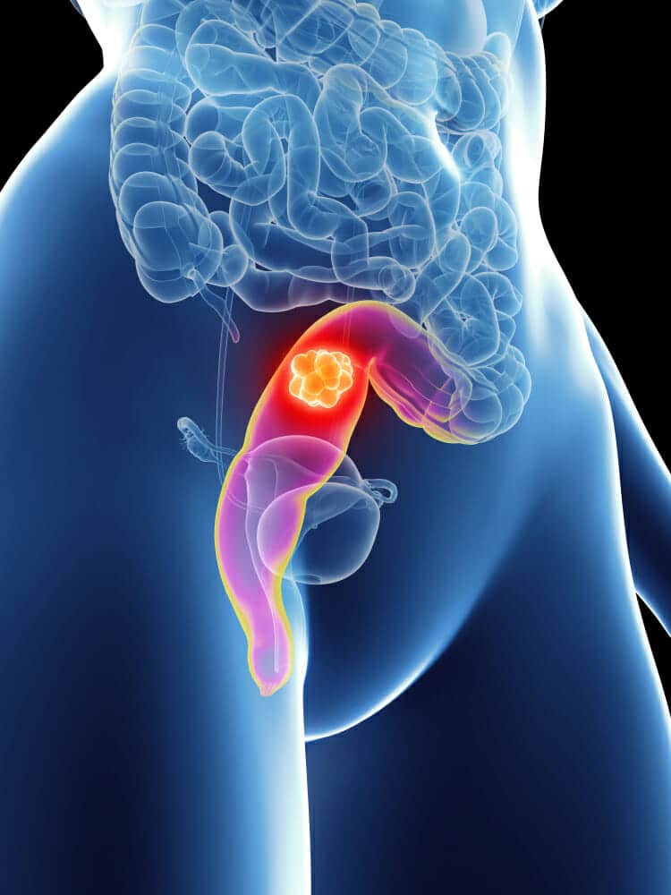 Rectal-Cancer - Γεώργιος Σάμπαλης Καρκίνος του ορθού