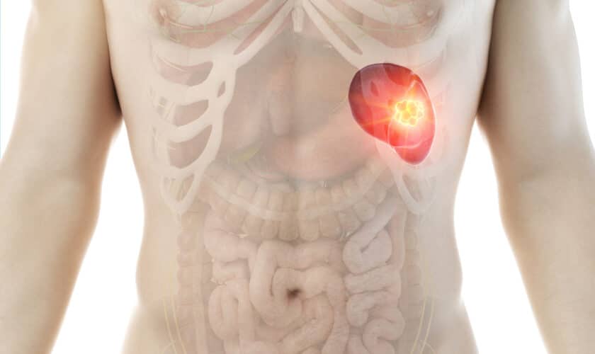 3d rendered medically accurate illustration of a mans spleen tumor - Γεώργιος Σάμπαλης Λαπαροσκοπική σπληνεκτομή