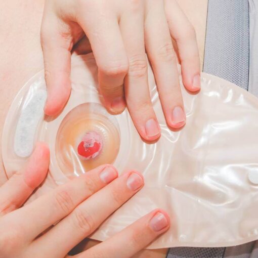 Κολοστομία