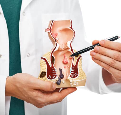 Η Χειρουργική Μέθοδος Milligan-Morgan για την Αντιμετώπιση Αιμορροΐδων