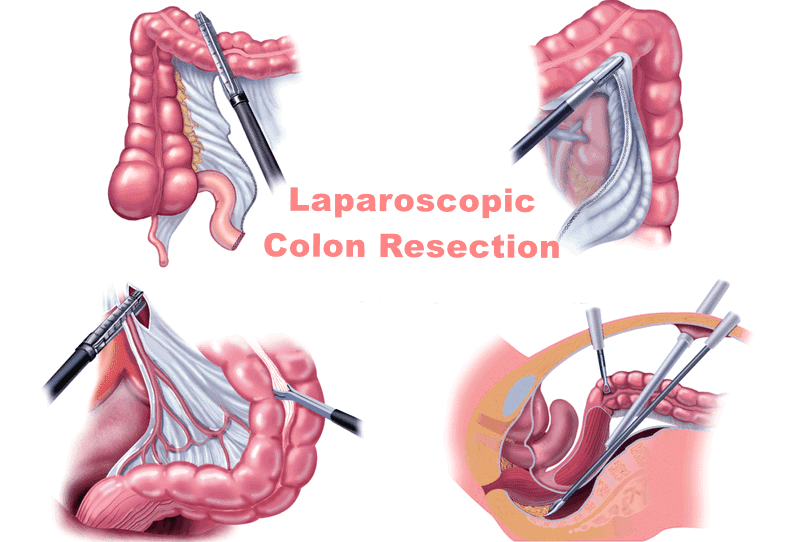 Νόσος Crohn - Ενδείξεις Χειρουργικής Αντιμετώπισης