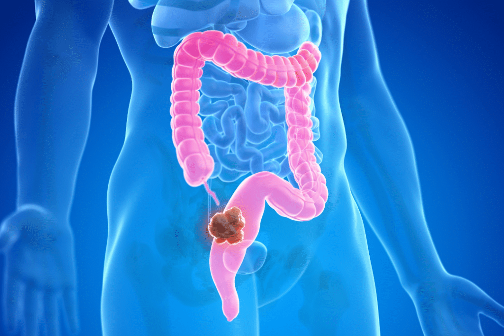 Προεγχειρητική ακτινοθεραπεία στον καρκίνο του ορθού