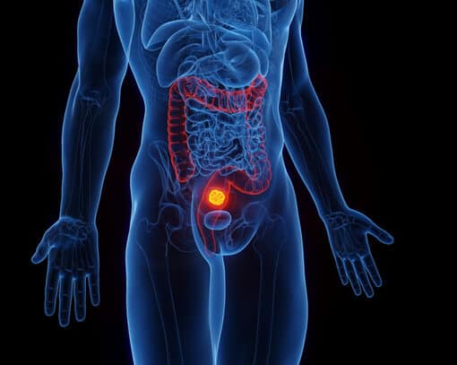 Προεγχειρητική ακτινοθεραπεία στον καρκίνο του ορθού