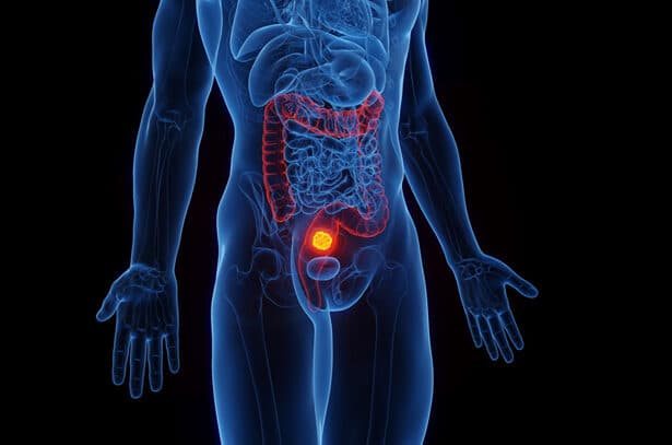 Προεγχειρητική ακτινοθεραπεία στον καρκίνο του ορθού