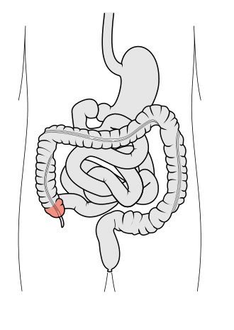 Λαπαροσκοπική δεξιά κολεκτομή στον καρκίνο του τυφλού: σύγχρονη προσέγγιση