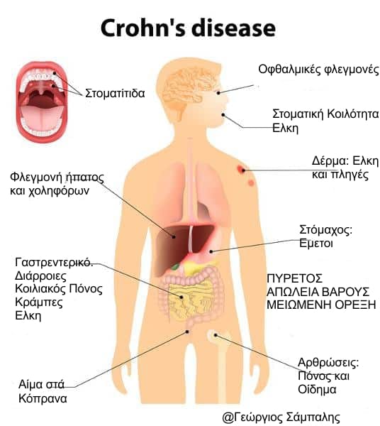 Νόσος Crohn - Ενδείξεις Χειρουργικής Αντιμετώπισης