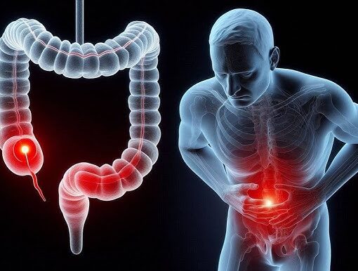 Πρώιμα Συμπτώματα του Καρκίνου του Παχέος Εντέρου και η Σχέση με την Ανατομία του