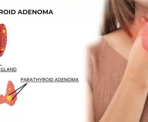 Αδένωμα παραθυρεοειδούς
