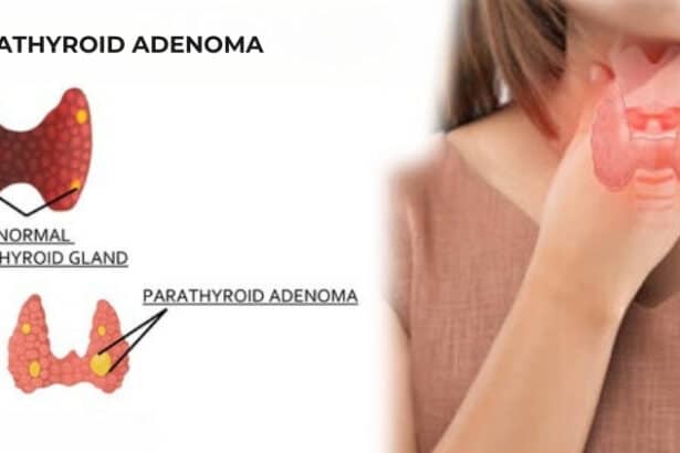 Αδένωμα παραθυρεοειδούς